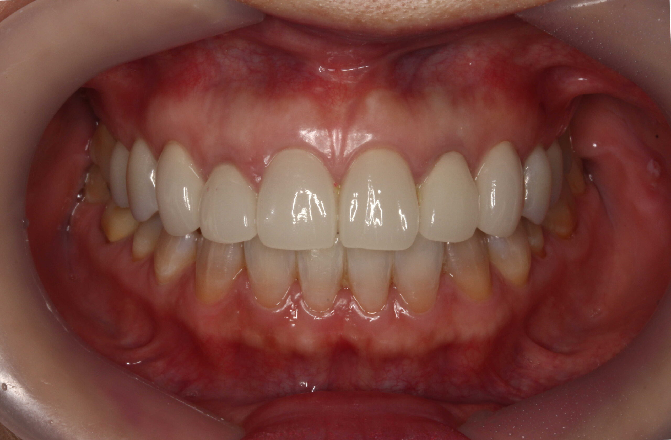 削らないラミネートベニアなら5DENTAL東京銀座がおすすめ