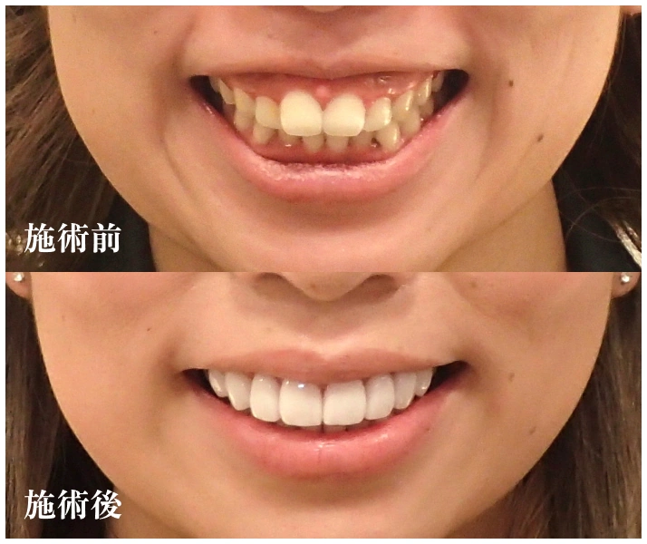 施術前、施術後写真