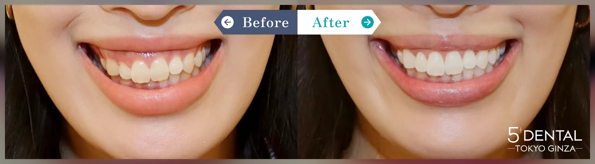 ビフォーアフター写真