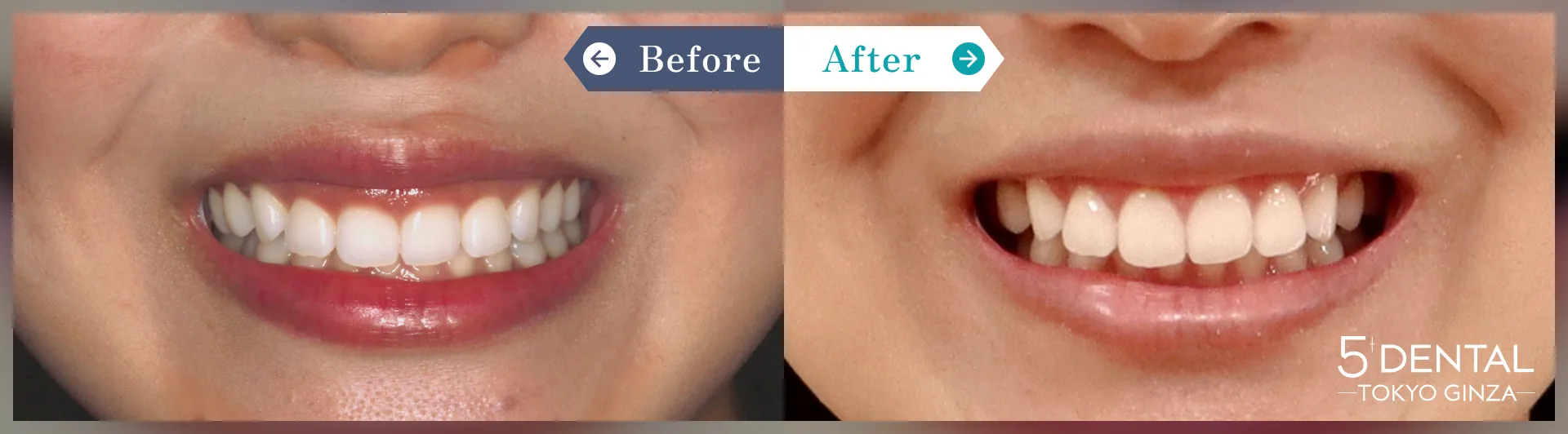 ビフォーアフター写真