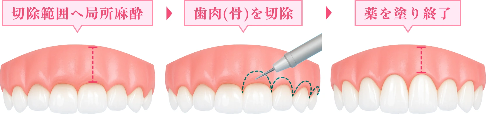 歯肉整形(骨整形)施術