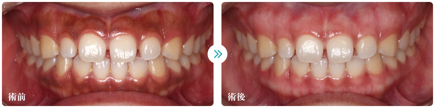 ガムピーリング 施術前、施術後写真