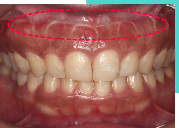外科的施術 口唇縫合術