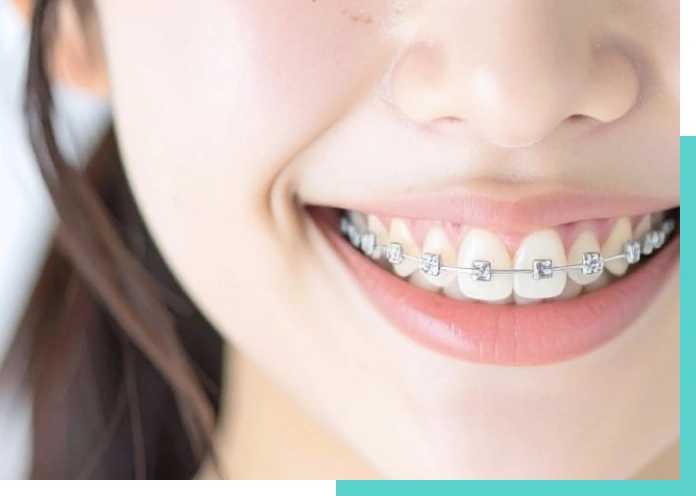 歯列矯正治療