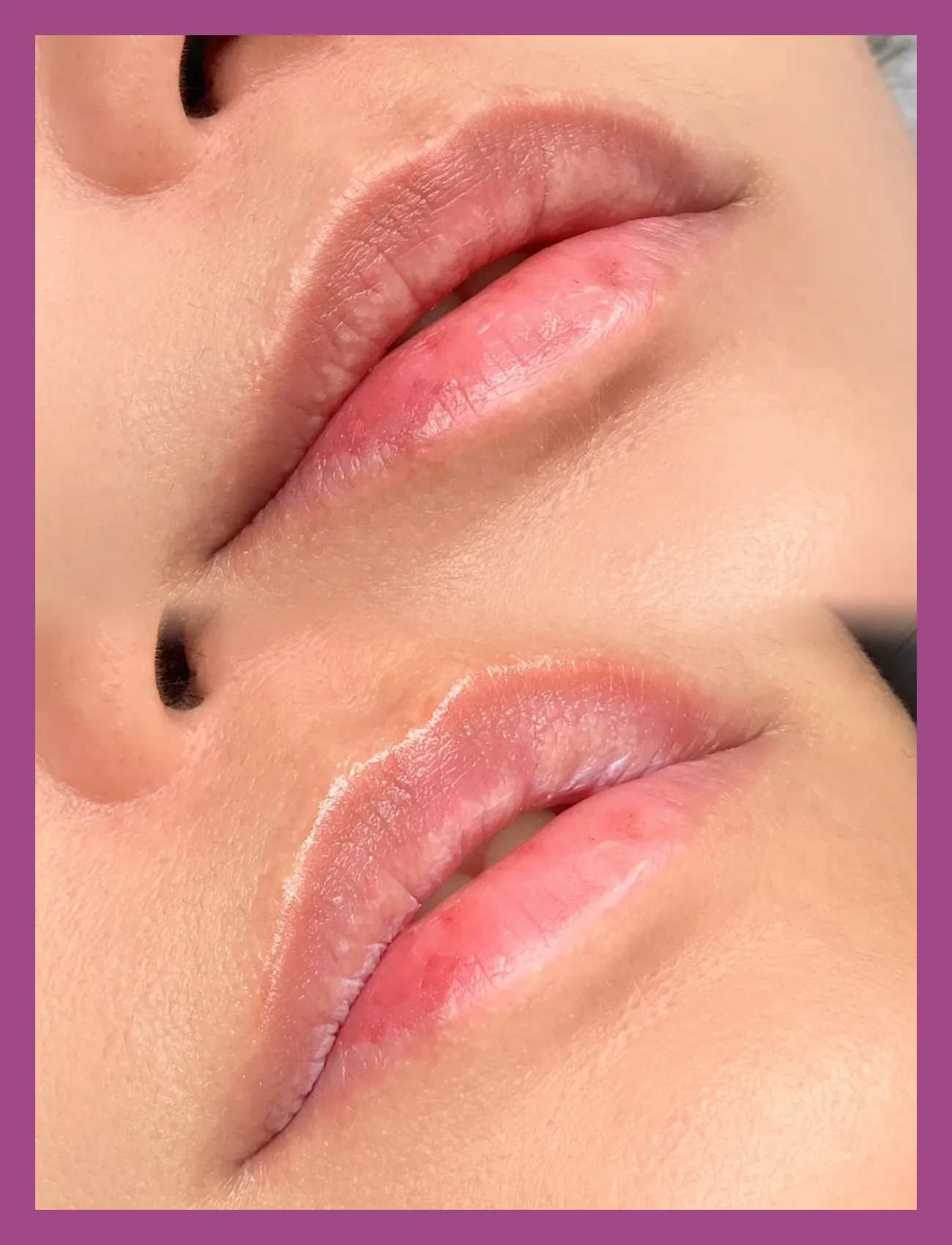 ローマピンク症例1のビフォーアフター