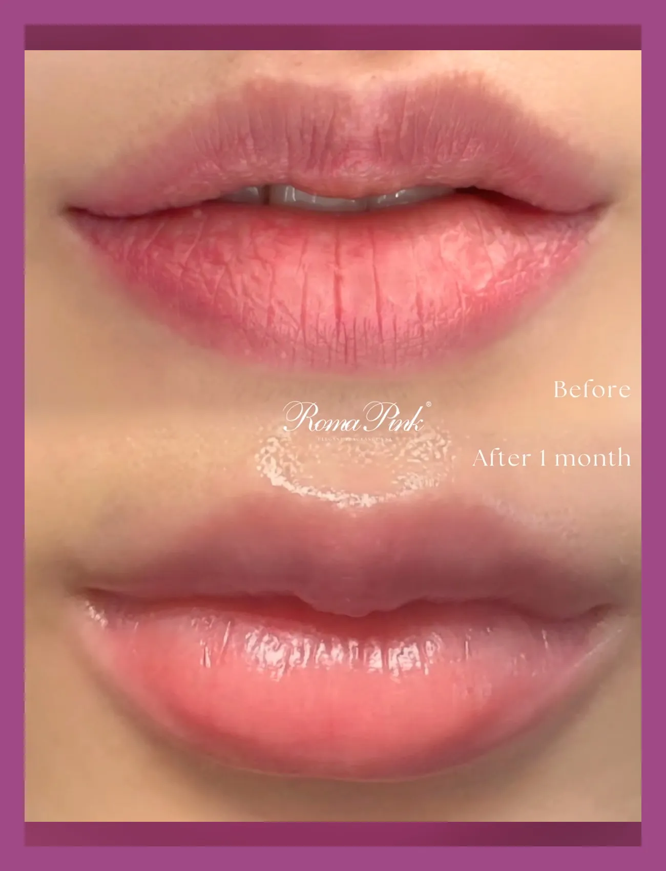 ローマピンク症例3のビフォーアフター