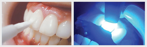 表面をツヤの出る薬剤で仕上げてレーザーで処置します