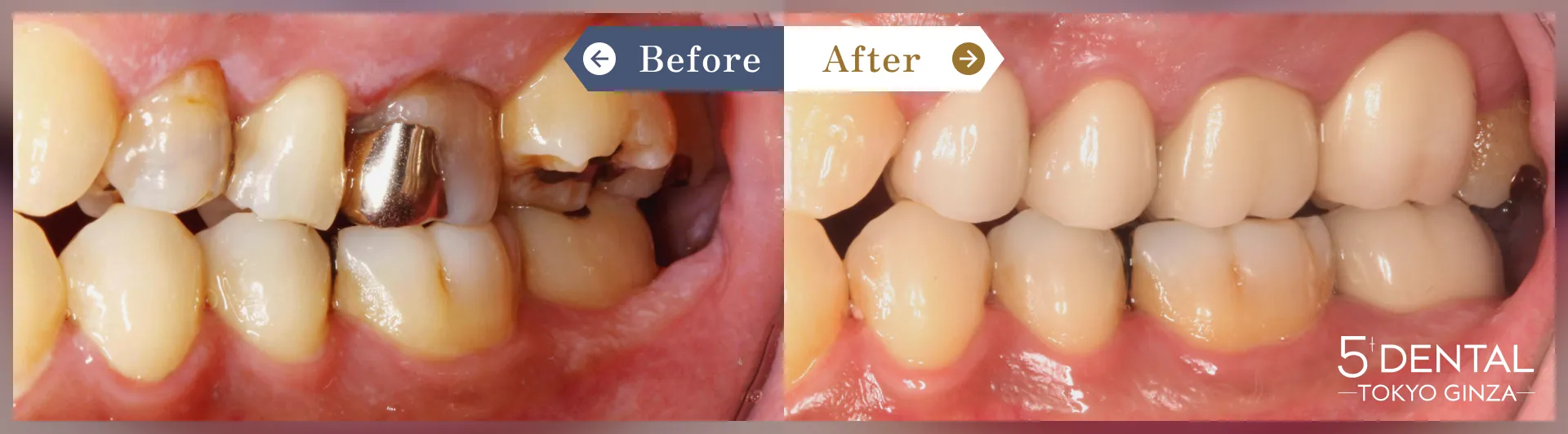 奥歯のセラミック治療 Before/After症例4