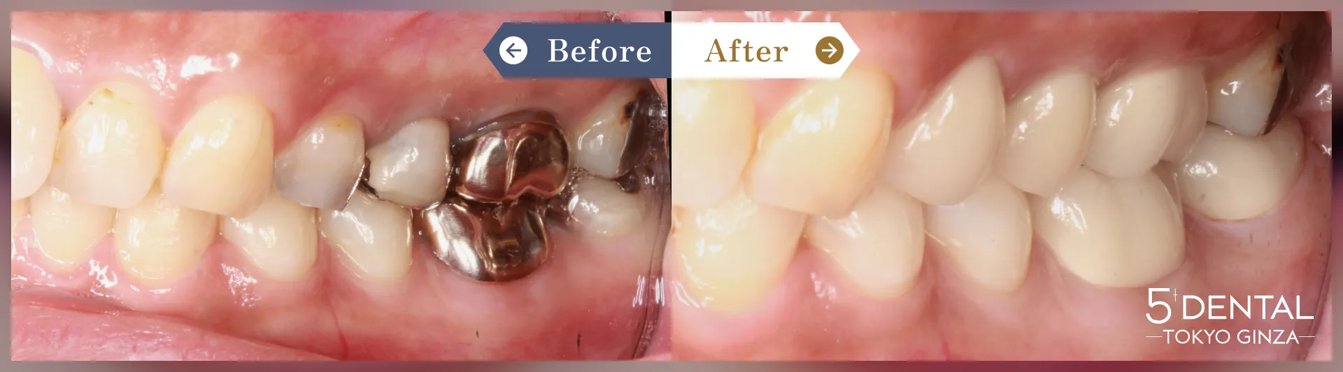 奥歯のセラミック治療 Before/After症例6