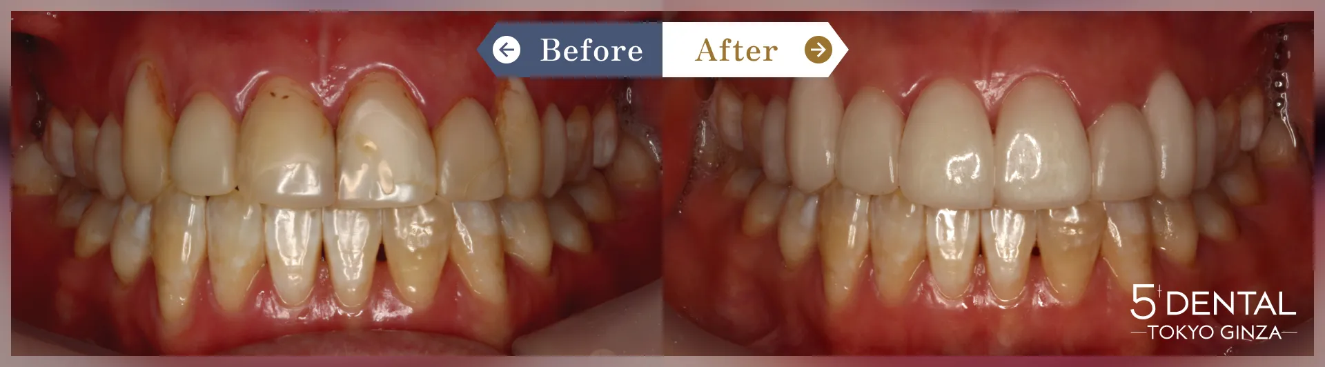 削らないラミネートべニア Before/After症例10