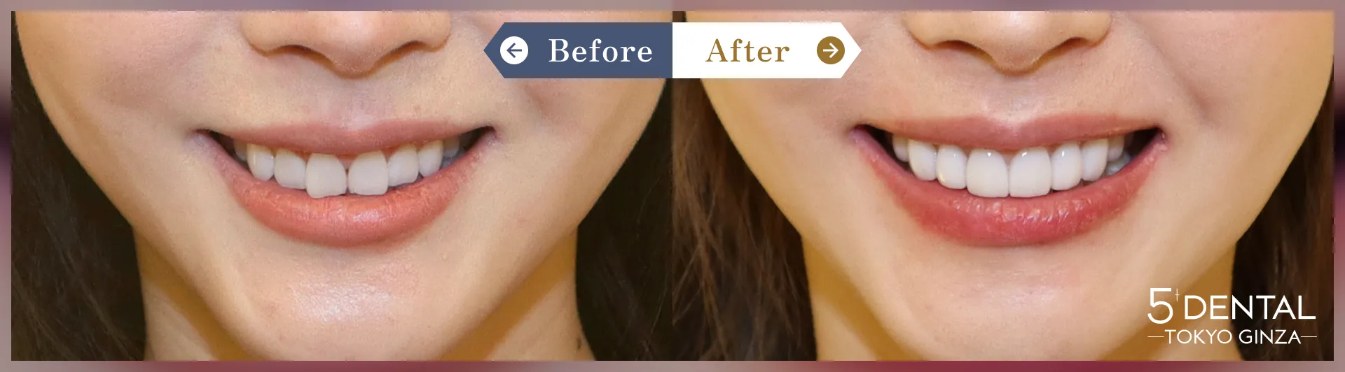 削らないラミネートべニア Before/After症例12