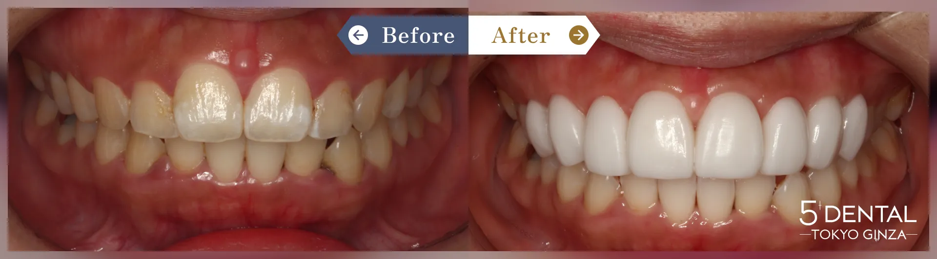 削らないラミネートべニア Before/After症例13