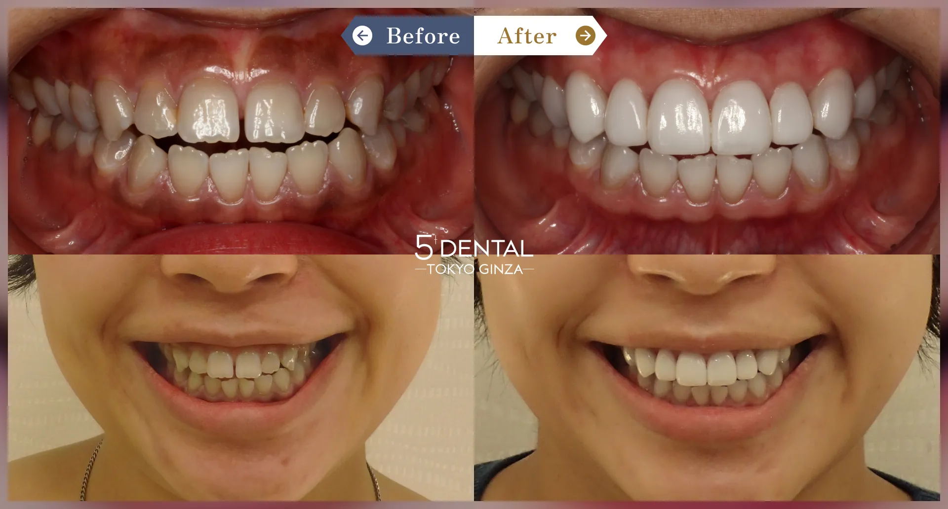 削らないラミネートべニア Before/After症例15