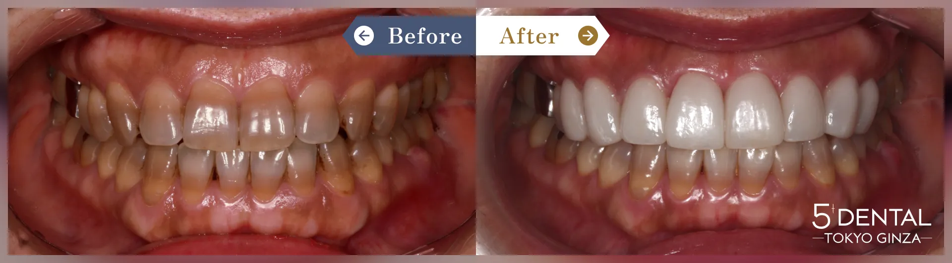 削らないラミネートべニア Before/After症例16