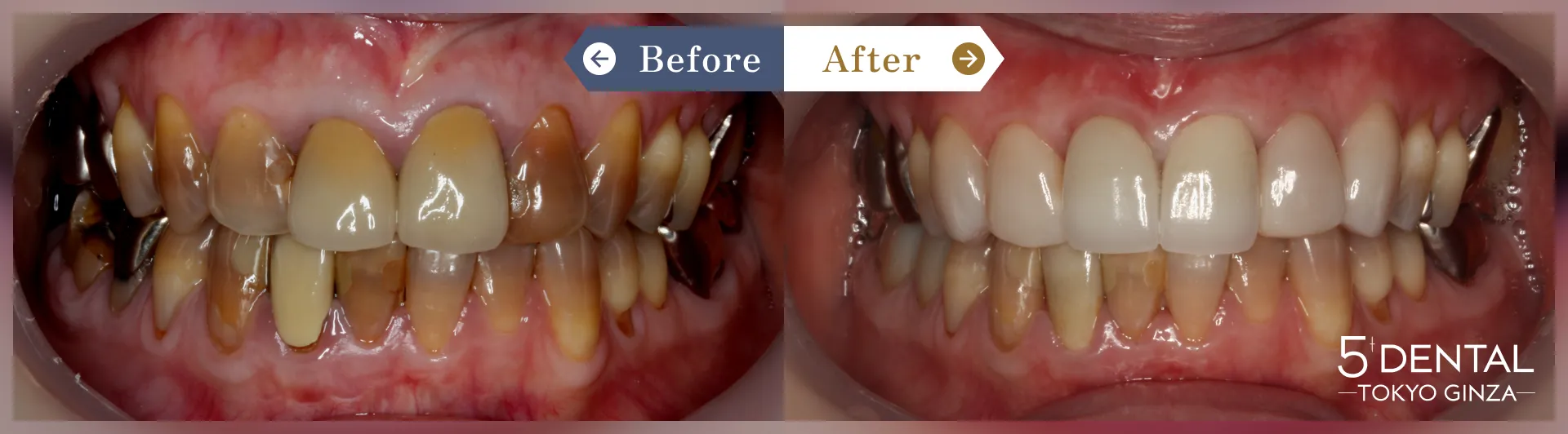 削らないラミネートべニア Before/After症例17