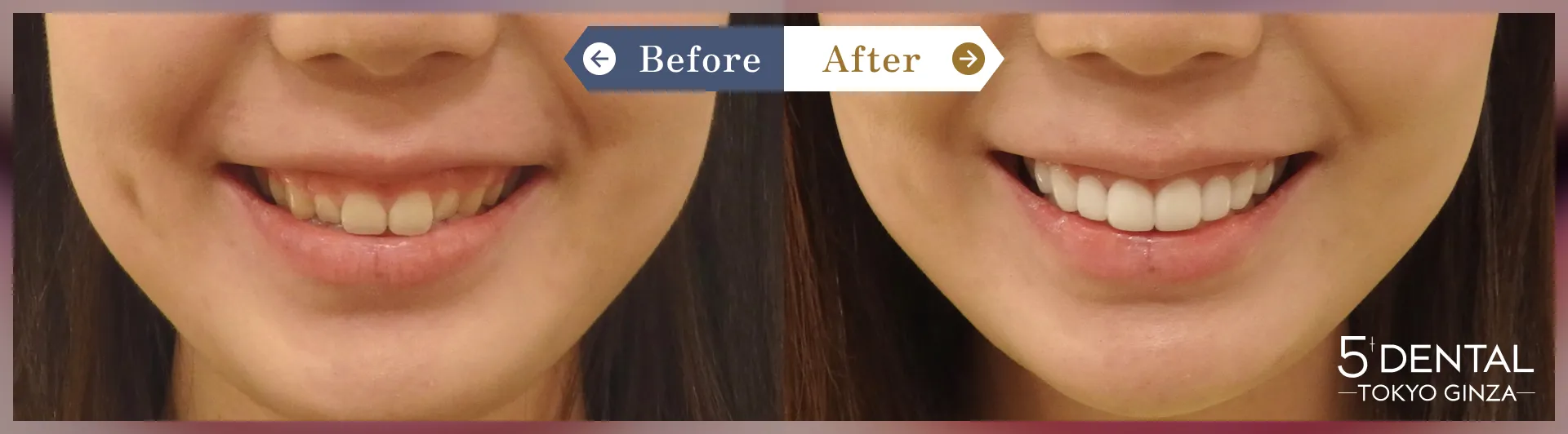 削らないラミネートべニア Before/After症例18