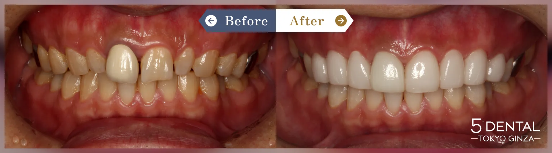 削らないラミネートべニア Before/After症例20