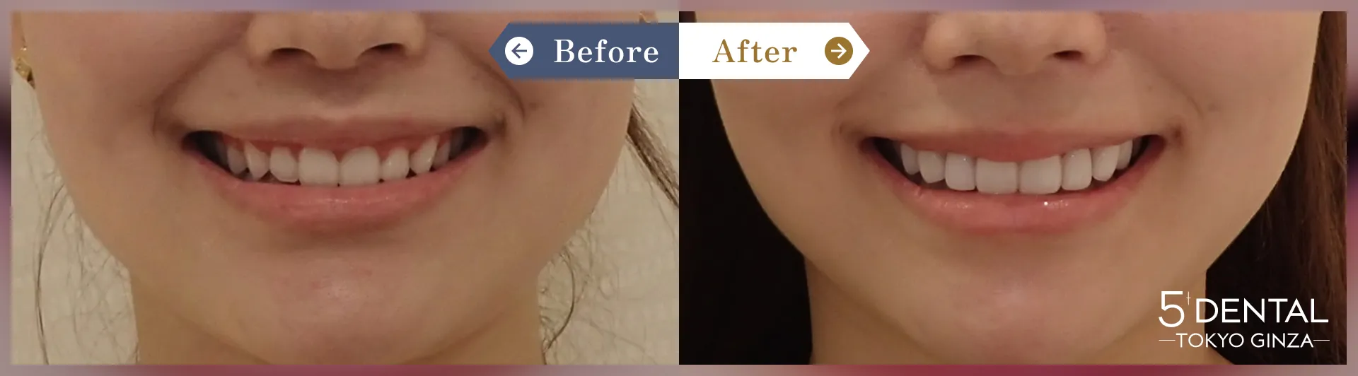 削らないラミネートべニア Before/After症例21