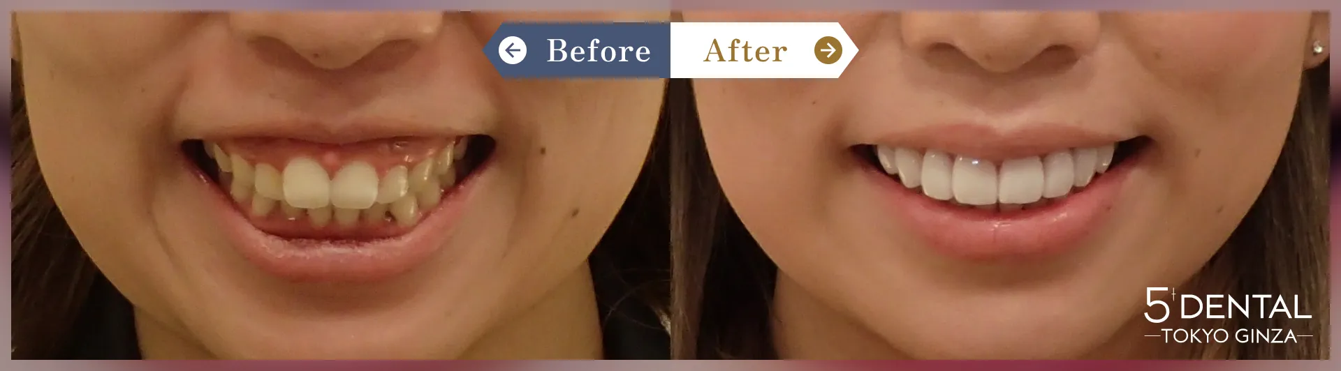 削らないラミネートべニア Before/After症例23