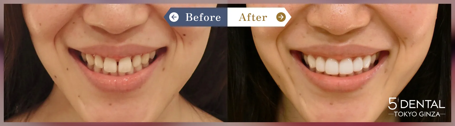 削らないラミネートべニア Before/After症例4