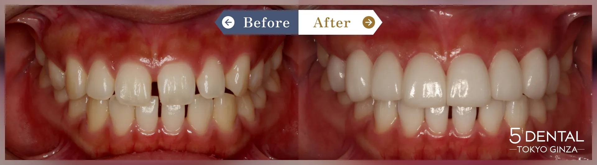 削らないラミネートべニア Before/After症例5