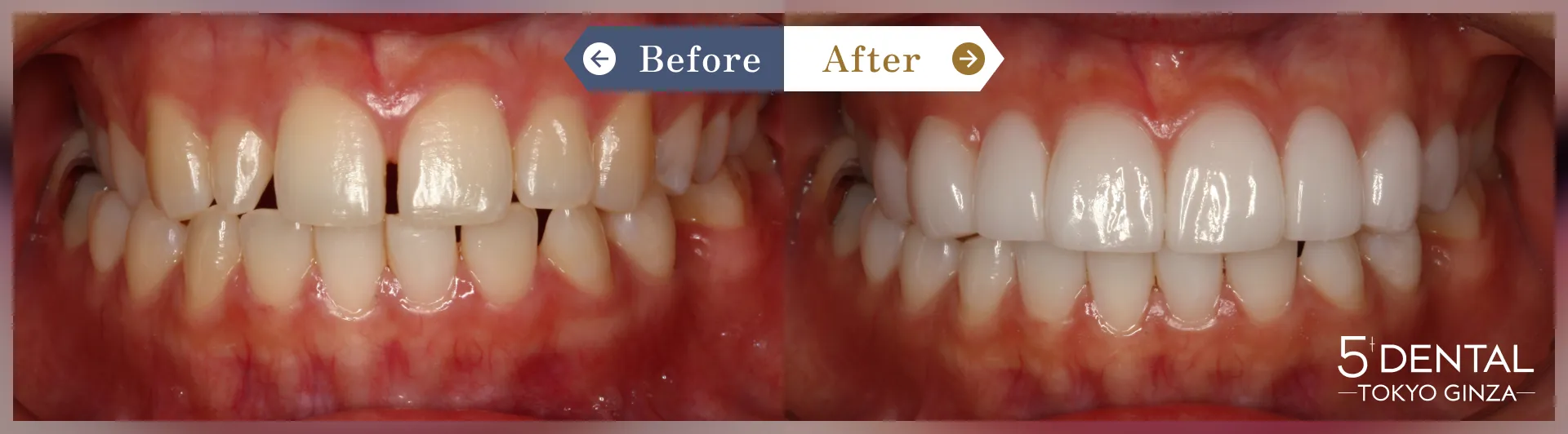 削らないラミネートべニア Before/After症例6