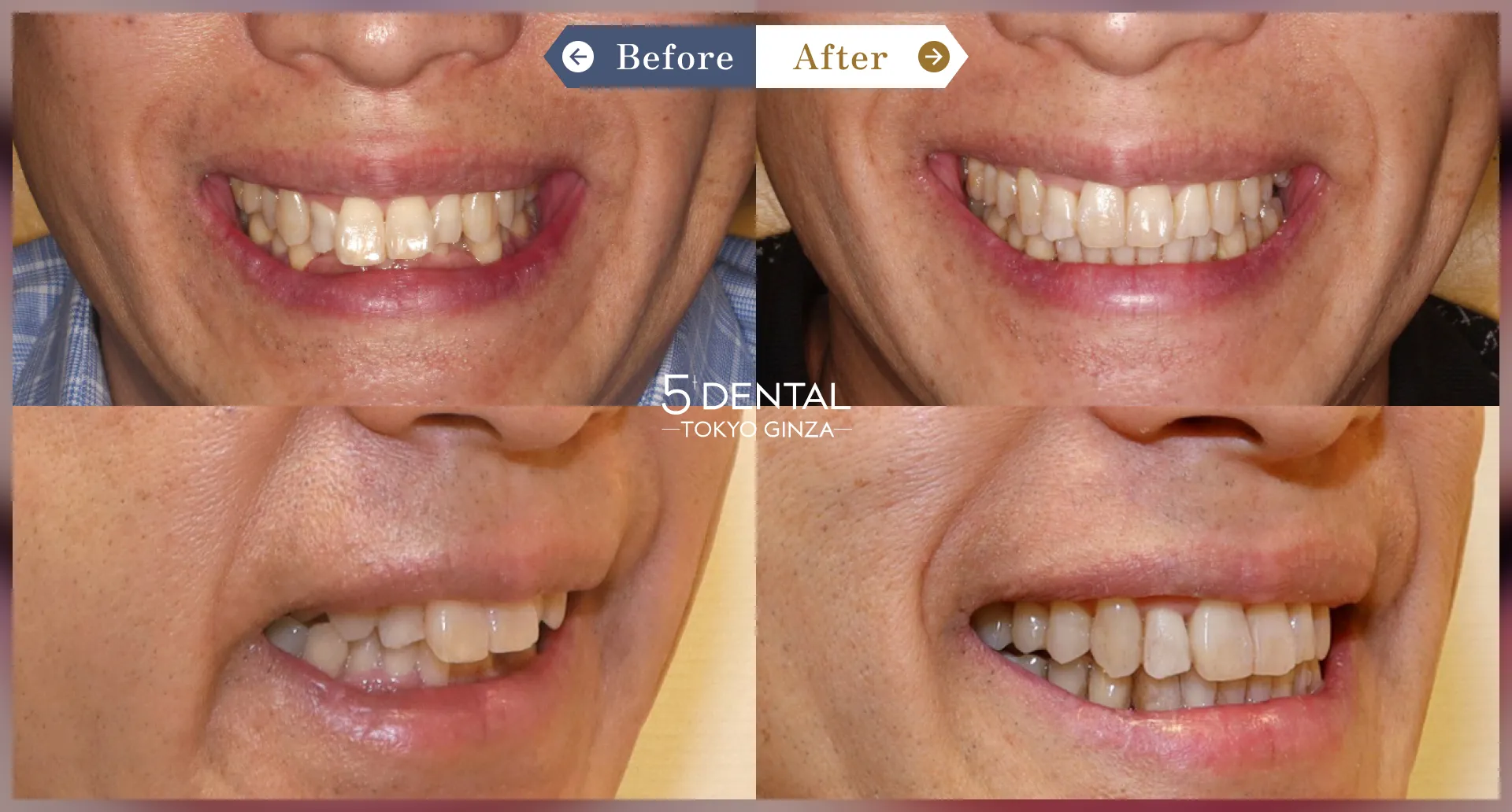 クリアコレクト Before/After症例