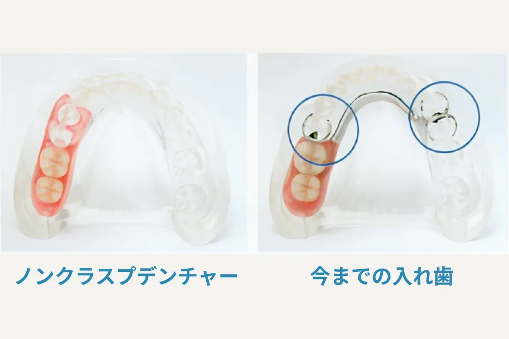 従来の入れ歯との比較