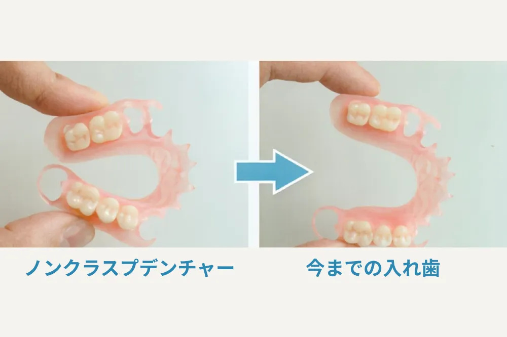 従来の入れ歯との比較