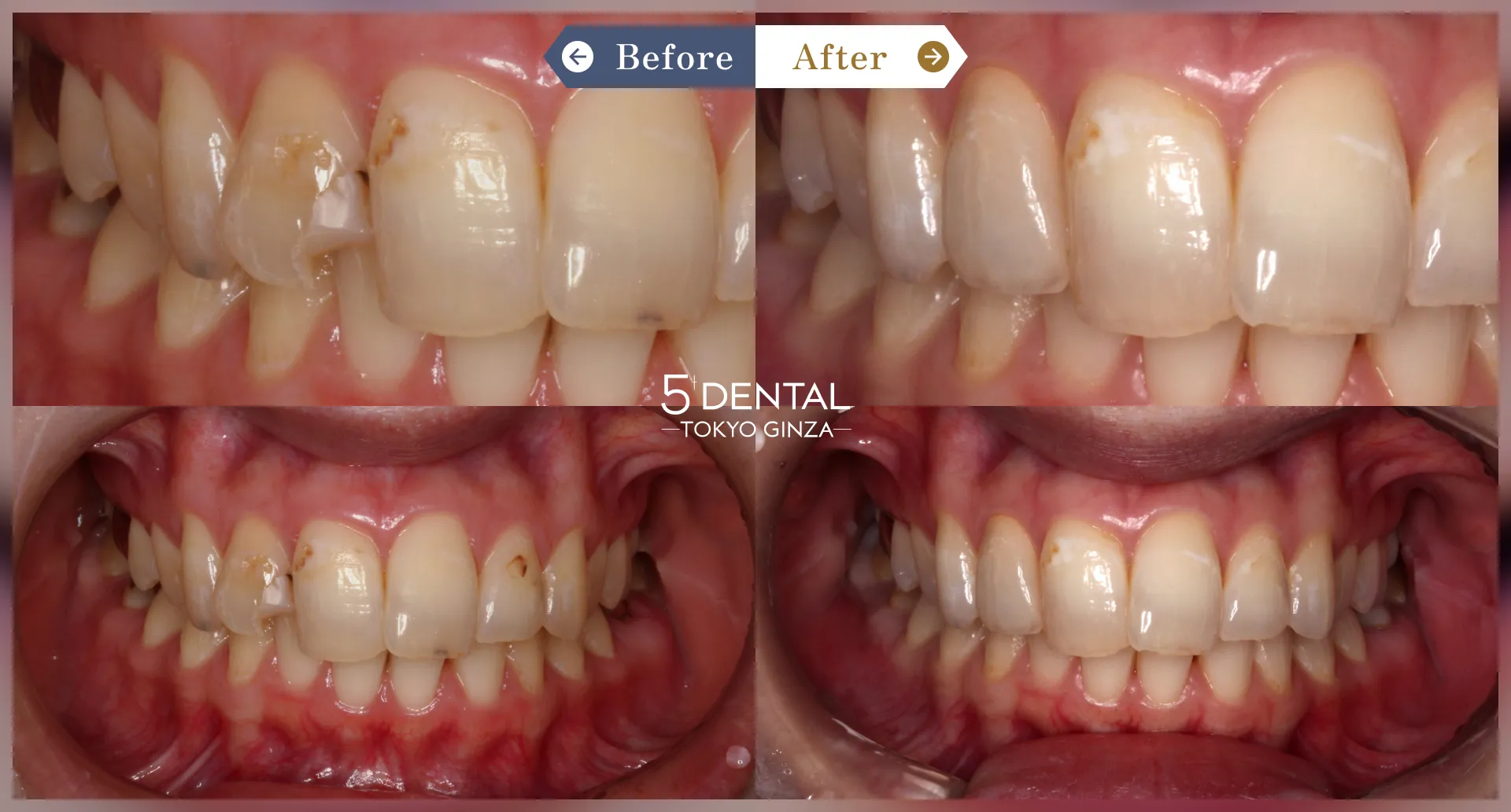 前歯のセラミックの症例 Before/After症例1