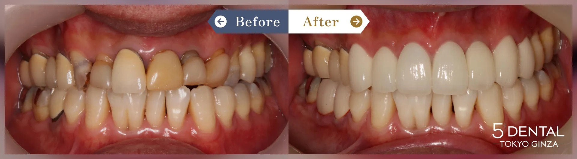 前歯のセラミックの症例 Before/After症例10