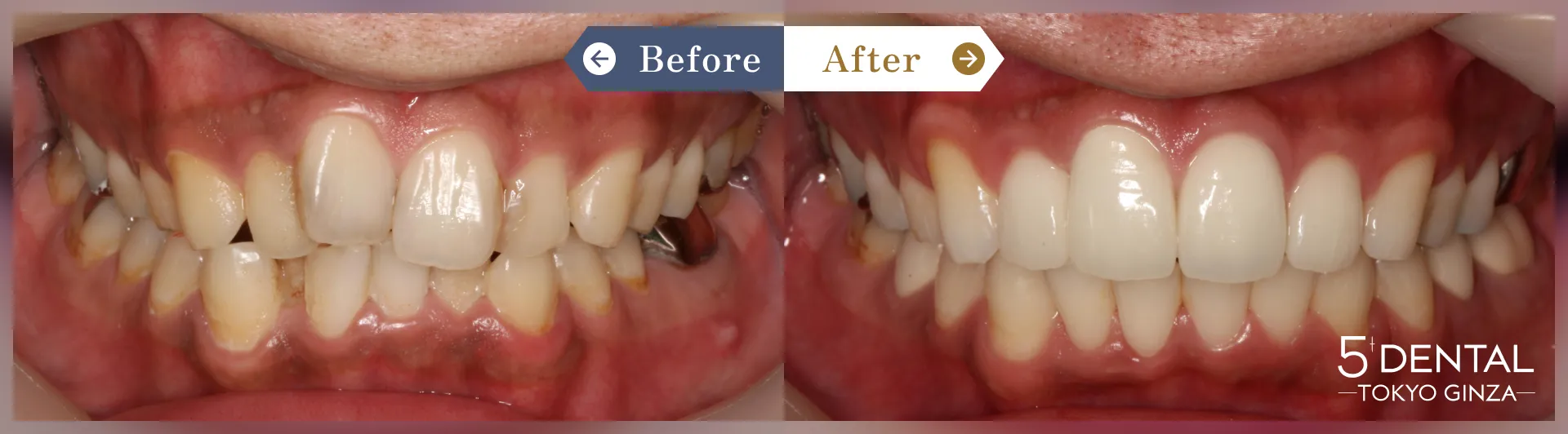 前歯のセラミックの症例 Before/After症例11