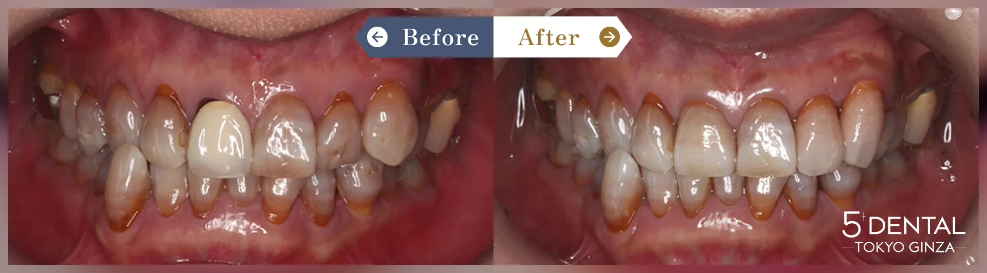 前歯のセラミックの症例 Before/After症例3