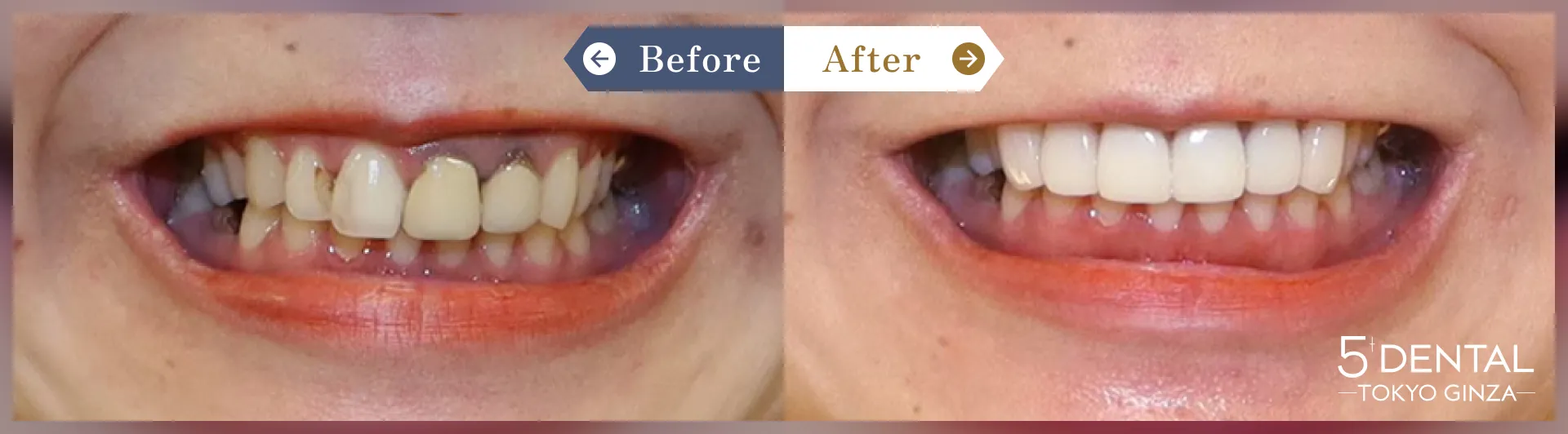 前歯のセラミックの症例 Before/After症例4