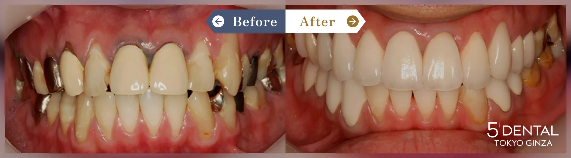 前歯のセラミックの症例 Before/After症例5