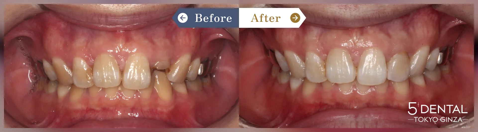 前歯のセラミックの症例 Before/After症例6