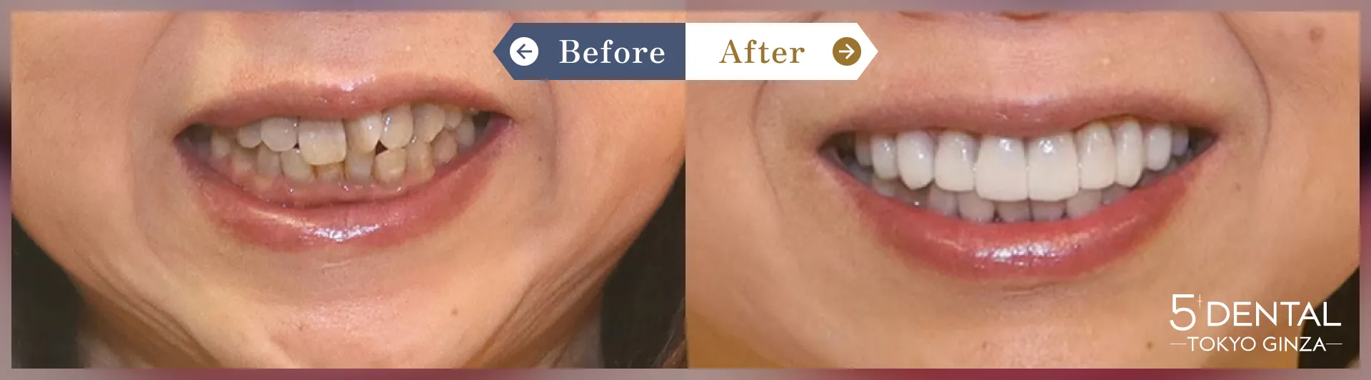 前歯のセラミックの症例 Before/After症例7