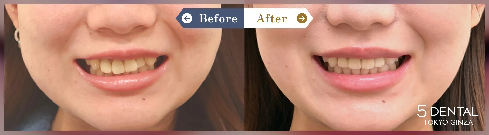 前歯のセラミックの症例 Before/After症例8