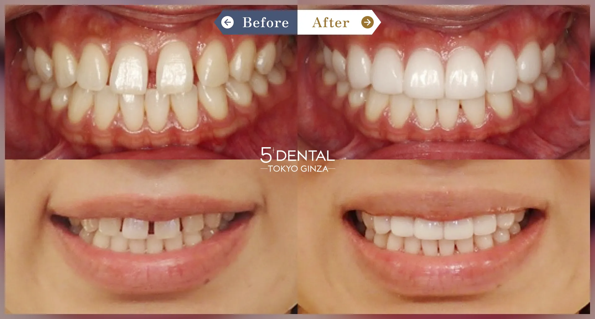 前歯の歯並び Before/After症例1