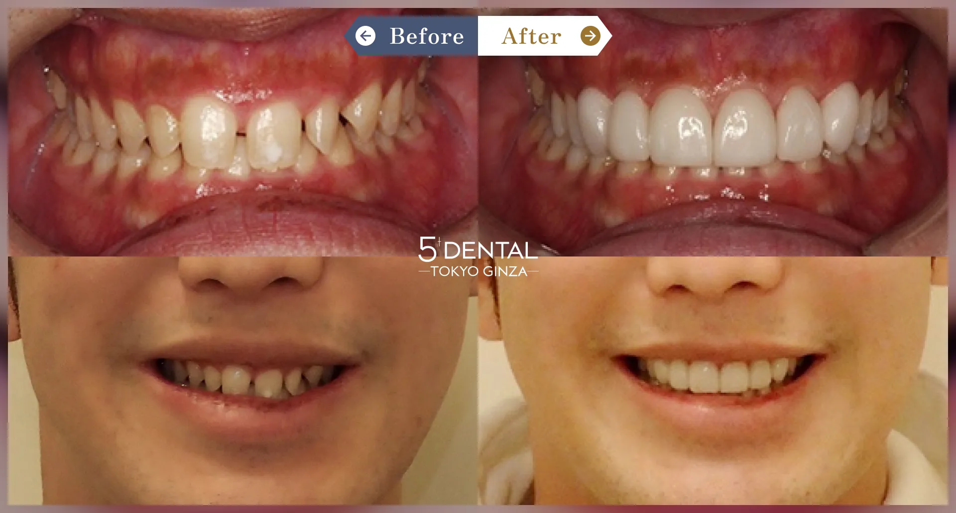 前歯の歯並び Before/After症例2