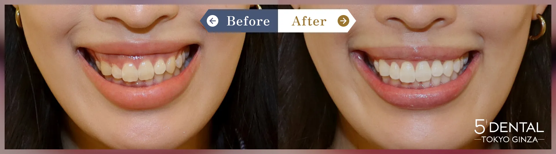 前歯の歯並び Before/After症例3