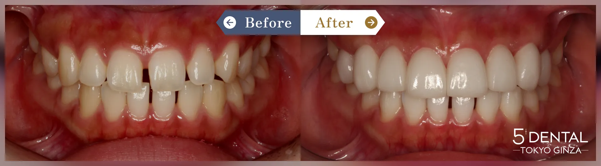 前歯の歯並び Before/After症例4