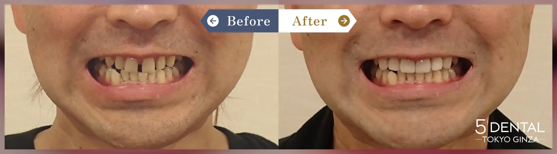 前歯の歯並び Before/After症例7