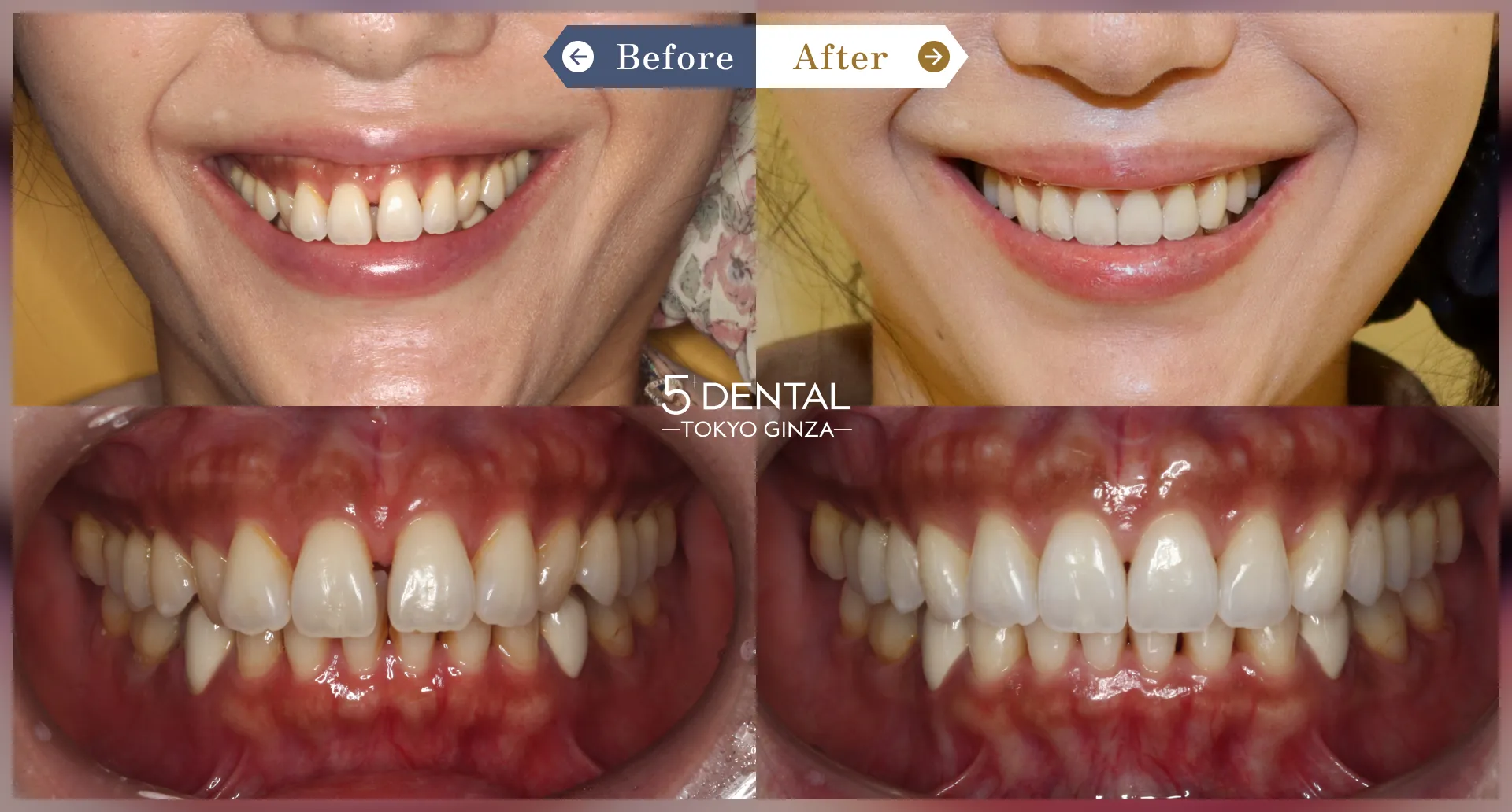 前歯の歯並び Before/After症例8