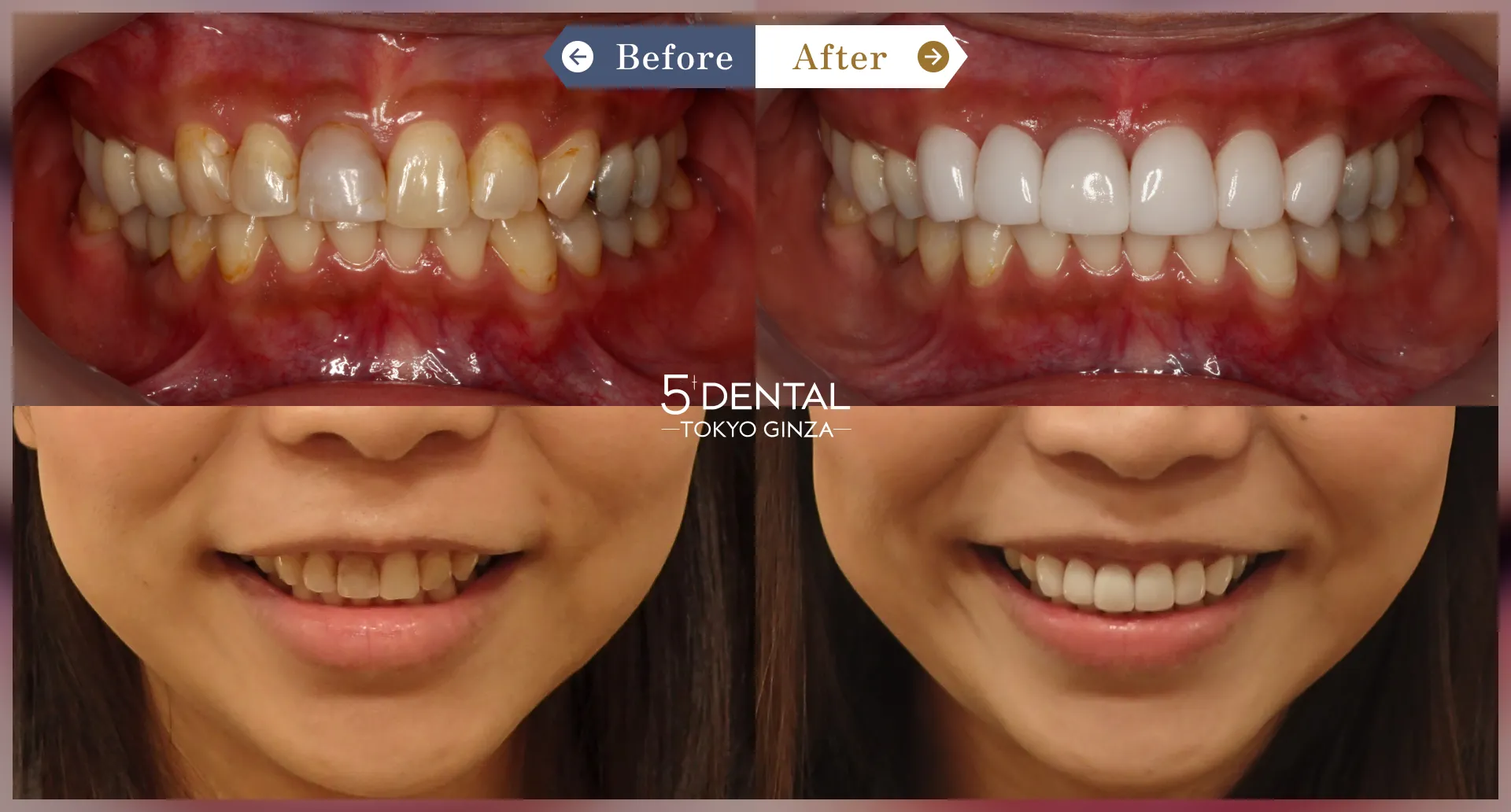 前歯の詰め物の変色 Before/After症例1