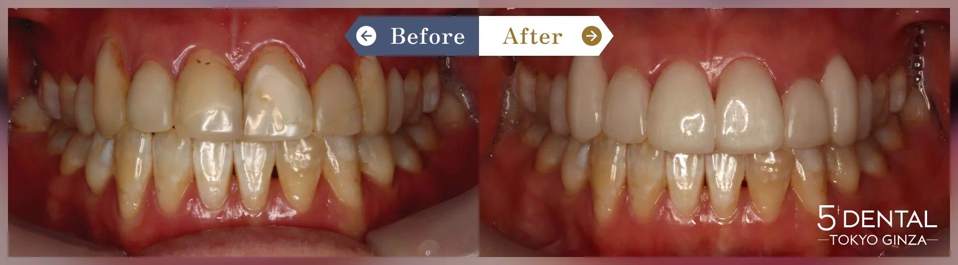前歯の詰め物の変色 Before/After症例2