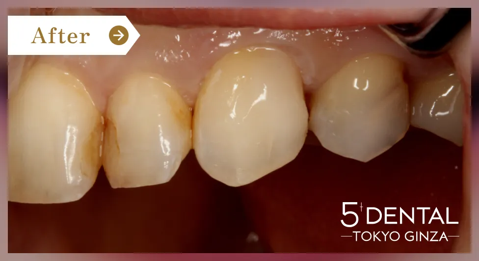 前歯の詰め物の変色 Before/After症例3-2
