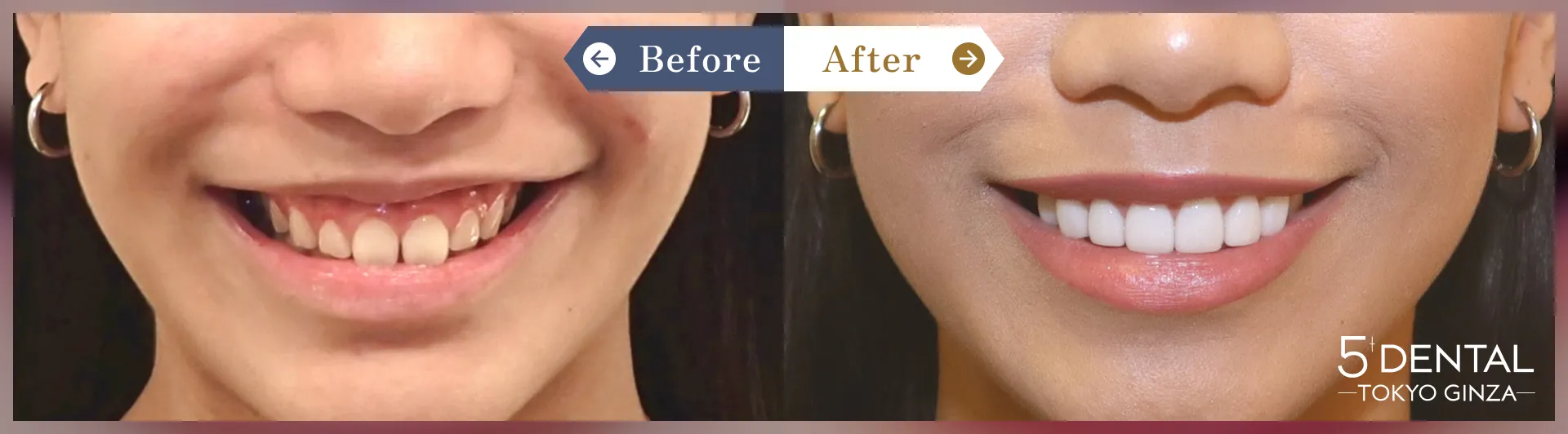 ガミースマイル治療 Before/After症例1