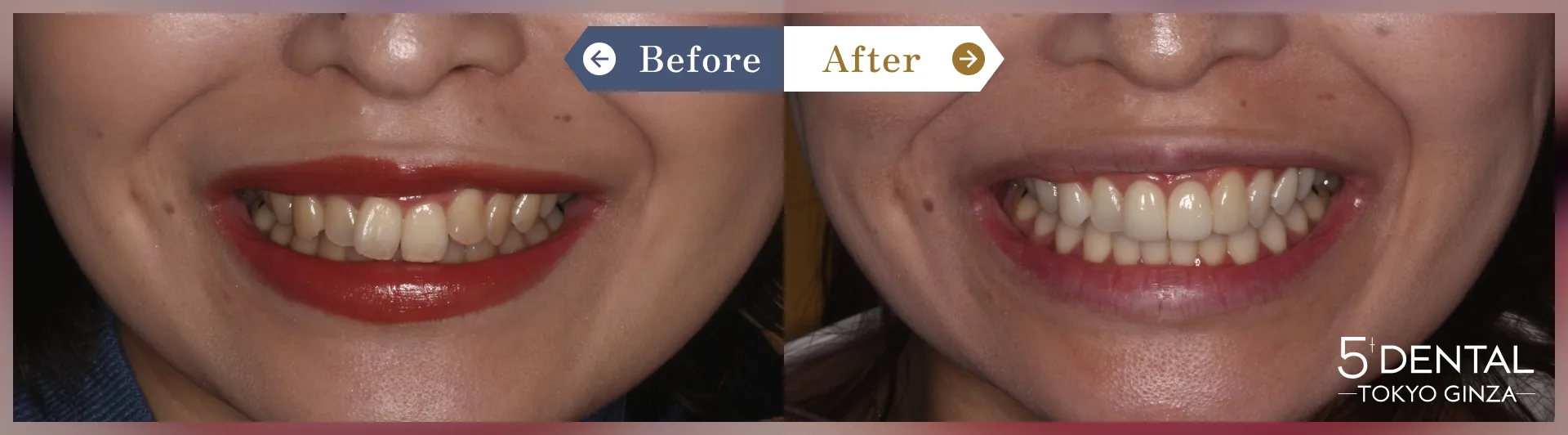 ガミースマイル治療 Before/After症例11