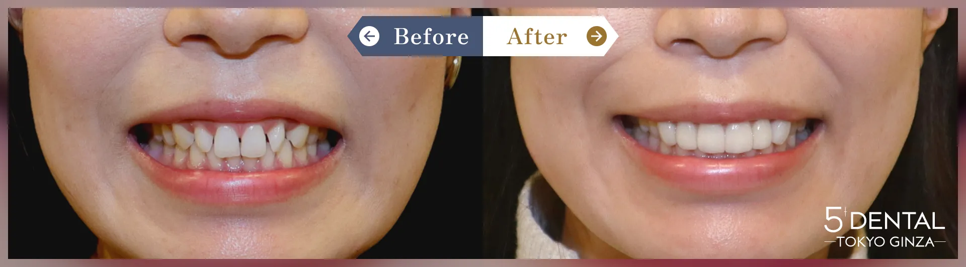 ガミースマイル治療 Before/After症例13